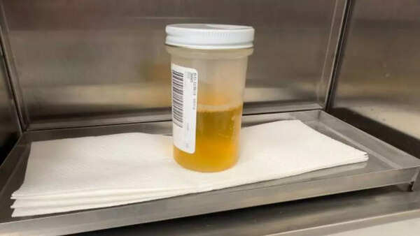 Dark urine and pale stool