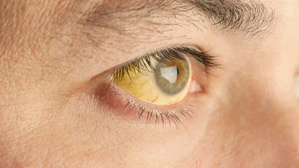 Yellowing of the skin and eyes