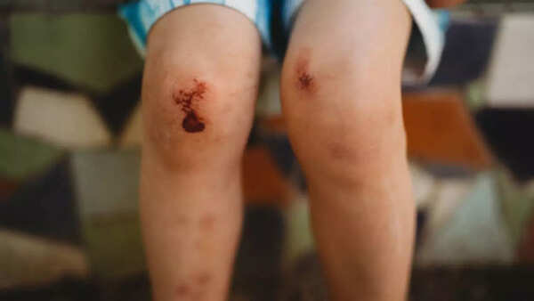 Body bruising and bleeding more rapidly