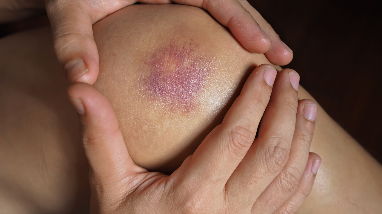 Easy bruising