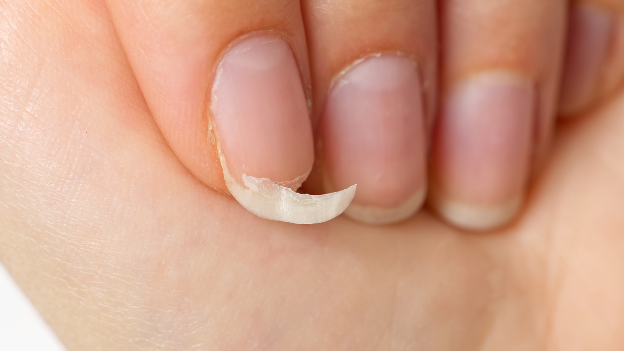 Brittle nails